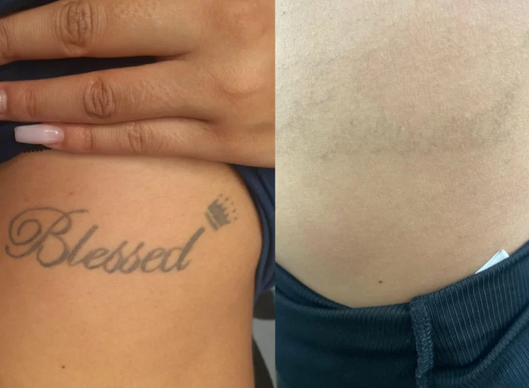 remocao-tatuagem-blessed
