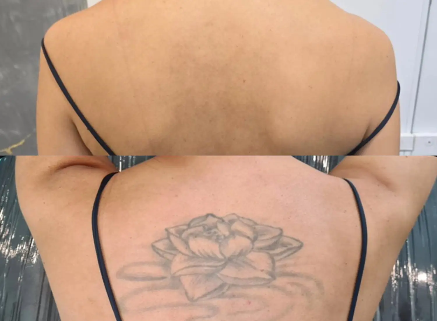 remocao-tatuagem-flor-costas