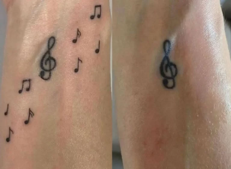 remocao-tatuagem-musica