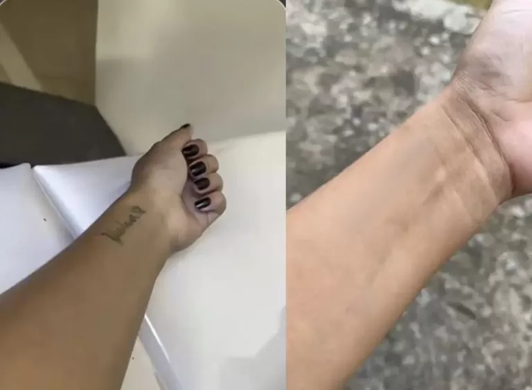 remocao-tatuagem-yeshua