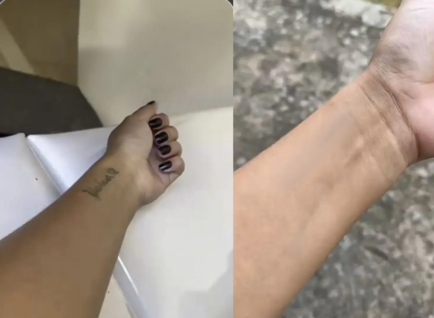 remocao-tatuagem-yeshua