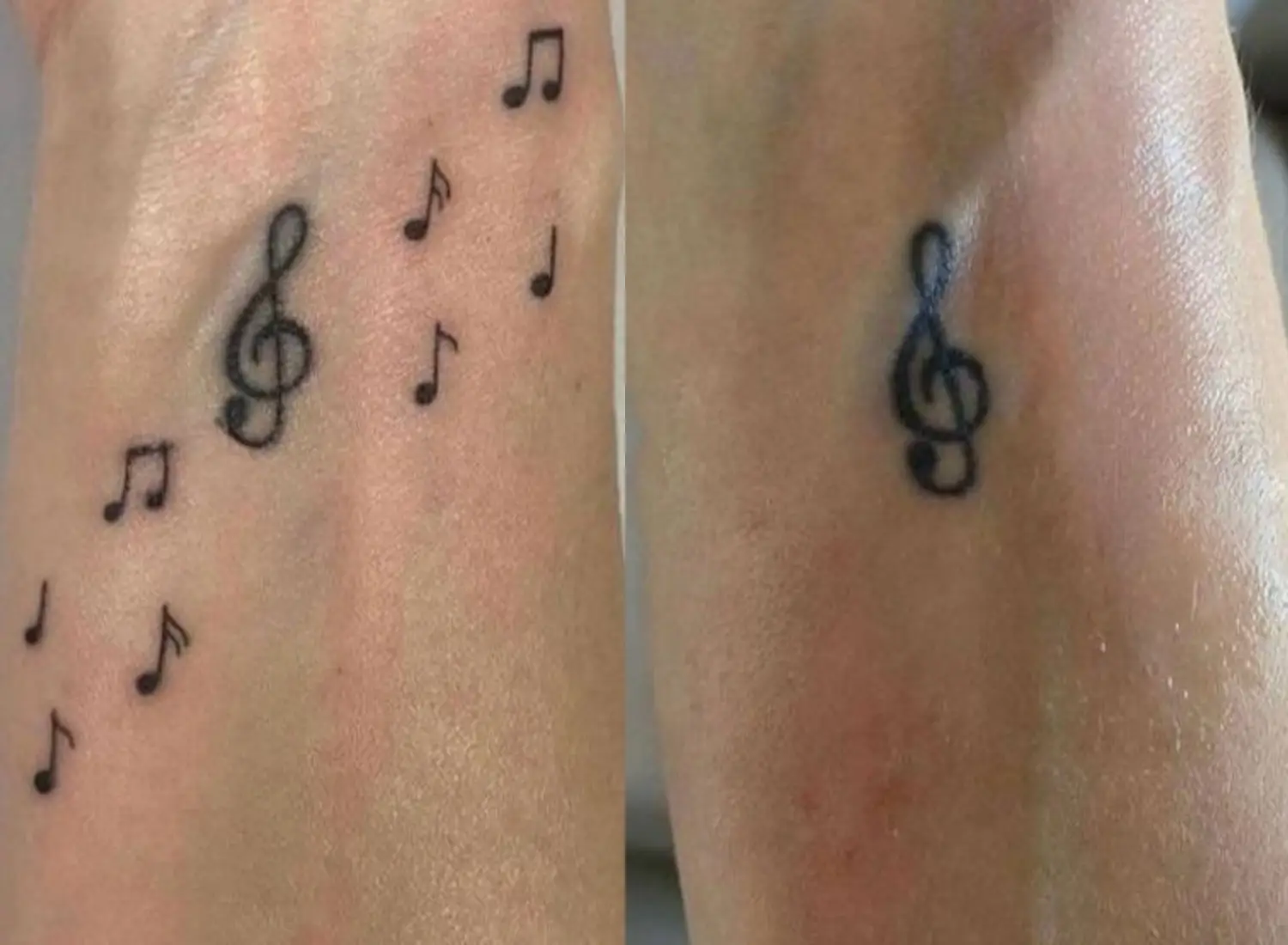 remocao-tatuagem-musica